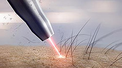 Épilation laser